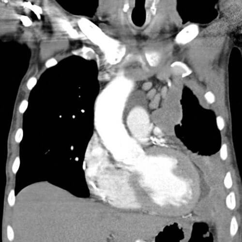 CT scan demonstrating the chest of a mesothelioma patient. From Wikipedia