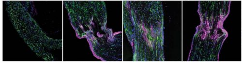 Large amounts of the protein mTOR (purple-red) appear rapidly in the nerve after injury (three images on the right); In the uninjured nerve (left) this protein is not found in such quantities