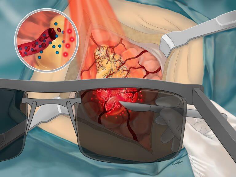 Illustration showing image-guided surgery after the injection of the Zohar smart sensor into the tumor and helps the surgeon distinguish between the cancerous tissue and the healthy tissue in real time (Illustration: Mein Harel)