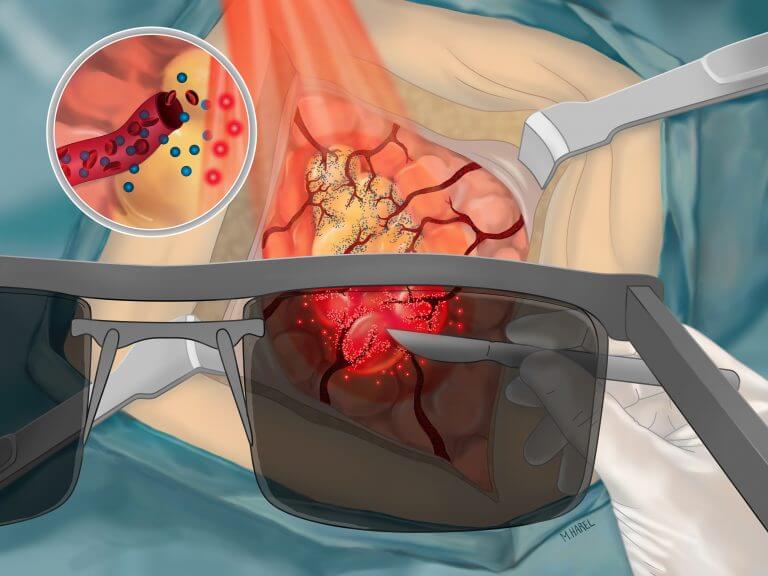 איור המראה ניתוח מונחה דימות לאחר הזרקה של חיישן חכם הזוהר בגידול ומסייע למנתח בזמן אמת להבחין בין הרקמה הסרטנית לרקמה הבריאה (איירה: מעין הראל)