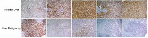 Staining of healthy liver tissue (the four right-hand images in the top row) reveals high levels of various enzymes (brown and reddish-brown) active in the urinary cycle, compared to low levels in cancerous tissue samples (the four right-hand images in the bottom row). In contrast, the markers for cell proliferation were low in the healthy tissue (top left) and very high in the liver cancer (bottom left). The coloring was done with the help of Dr. Raya Elam