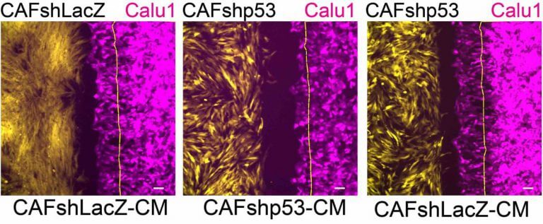 The effect of p53 in fibroblast cells on cancer cell migration: cancer cells (magenta red) migrate towards cancer-supporting fibroblasts (yellow) expressing the p53 gene (left); Migration is reduced (center) when p53 is silenced in fibroblasts; When substances secreted by the cancer-supporting fibroblasts are added to the cell culture, migration returns to normal (right). Illustration, Weizmann Institute