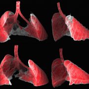 בתמונה שני מבטים (קדמי ואחורי) של הדמיית ריאות של עכבר הלוקה בפיברוזיס (איזורים הצבועים באפור), לפני ואחרי קבלת ננו טיפול ישירות לתאים החולים.