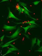 תאי T של המערכת החיסונית (באדום) תוקפים תאי סרטן מסוג מלנומה (בירוק). תאי T ש"יודעים" לקרוא "תמרורים" על גבי התאים הסרטניים יעילים במיוחד בהשמדתם. איור: פרופ' ירדנה סמואלס, מכון ויצמן