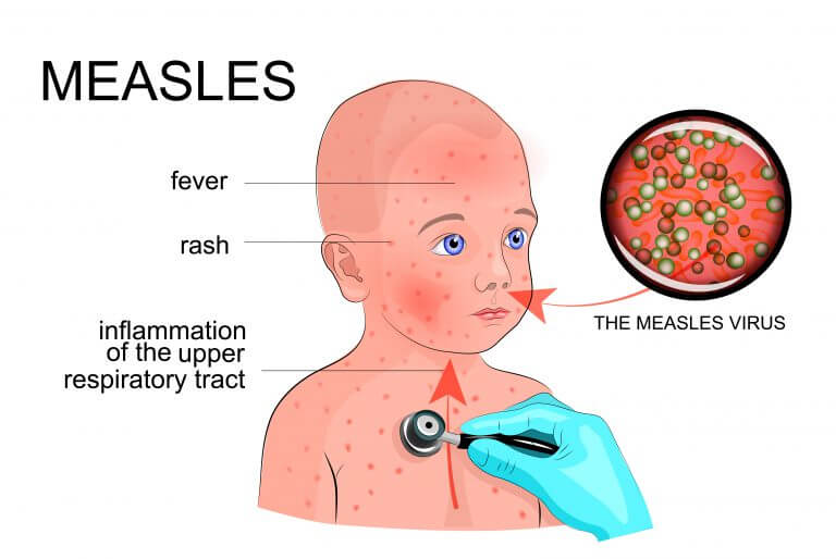 Measles symptoms. Illustration: shutterstock