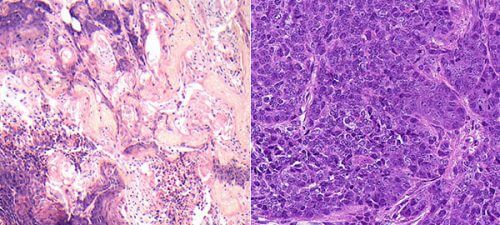 Tumors in the mammary glands of mice under a microscope: tumors in which the LATS1 gene is missing develop characteristics of basal breast cancer (left); Tumors lacking the LATS2 gene have luminal characteristics and metabolic changes (right)