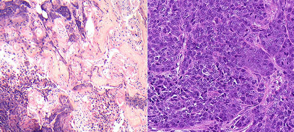 Tumors in the mammary glands of mice under a microscope: tumors in which the LATS1 gene is missing develop characteristics of basal breast cancer (left); Tumors lacking the LATS2 gene have luminal characteristics and metabolic changes (right)