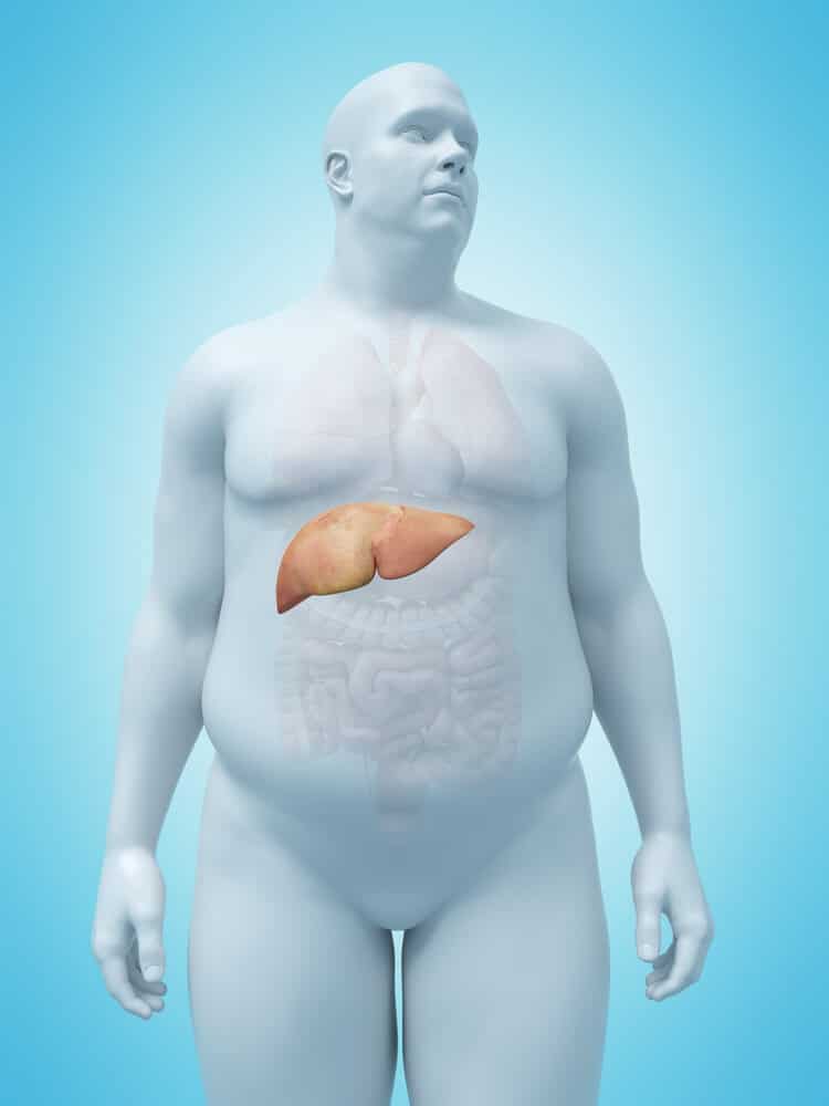 الكبد الدهني لدى الأشخاص الذين يعانون من زيادة الوزن. الرسم التوضيحي: شترستوك