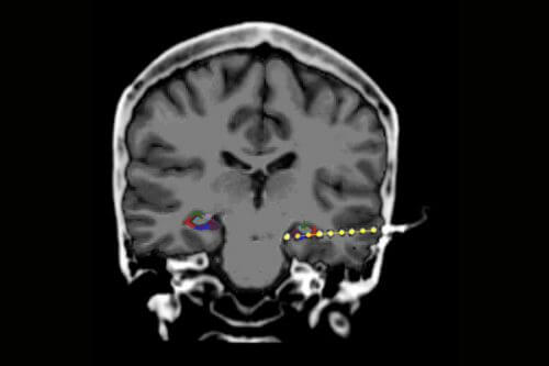 סריקת MRI המציגה אלקטרודה תוך-גולגולתית (מסומנת בצהוב) שהושתלה בהיפוקמפוס של מטופל העובר ניטור אפילפסיה. ההיפוקמפוס על אזוריו השונים מסומנים על-גבי הסריקה באדום, ירוק, סגול וכחול, כאשר ההתפרצויות העצביות המכונות "אדוות" (Ripples) נוצרות באזור האדום המכונה CA1. ממעבדתו של פרופ' רפי מלאך, מכון ויצמן
