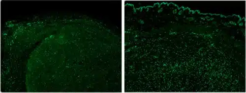 החוקרים הופתעו לגלות כי בעוד שבגידולים הומגניים (מימין) תאי T (נקודות ירוקות) נכנסו לתוך ליבת הגידול, באלו ההטרוגניים (משמאל) הם נותרו מחוץ לגידול. איור: מעבדתה של פרופ' ירדנה סמואלס, מכון ויצמן