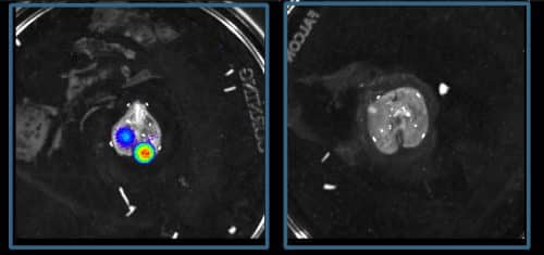 Lungs of an untreated mouse with Ewing's sarcoma (left) containing many cancer cells (highlighted) that have spread from the bones, compared to almost completely clean lungs of a mouse treated with a drug that reduces glucocorticoid production (right)