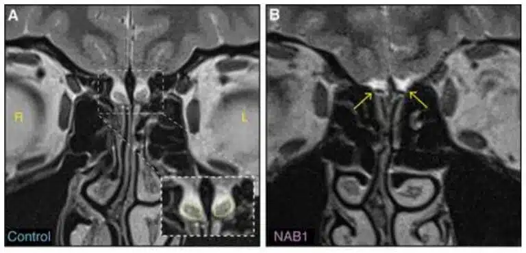 Magnetic resonance imaging of a subject without a olfactory bulb (right) and a subject with a olfactory bulb (left). Both with a completely normal sense of smell