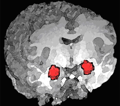 האמיגדלה (באדום) – מבנה מוחי דמוי שקד הנמצא בעומק האונה הרקתית של יונקים רבים, ובהם האדם. מעורבת בתהליכי למידה אסוציאטיבית שבהם נוצרת זיקה בין קלט חושי מסוים לחוויות חיוביות או שליליות צילום: פרופ' רוני פז, מכון ויצמן