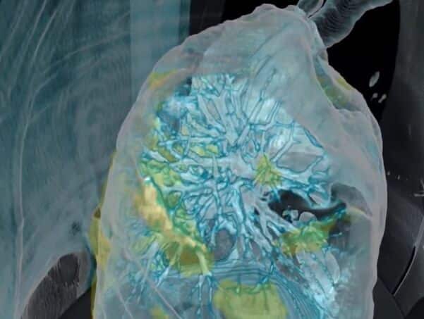 Simulation of the impact of the corona virus on the lungs. Photo: Surgical Theater