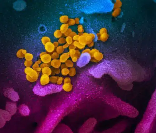 The new corona virus that causes COVID-19 (yellow) appears on the surface of cells (blue/pink) in culture in the laboratory. NIAID Laboratories (RML), USA NIH, CC BY NIAID Rocky Mountain