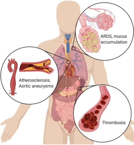 In the lungs, it is NETs that drive the accumulation of sputum in the airways of cystic fibrosis patients. They also accelerate the development of acute respiratory distress syndrome, which arises due to a variety of reasons, including the flu. In the vascular system, they cause arteriosclerosis and arteriovenous aneurysms as well as thrombosis (thrombosis, especially microbrbrosis), and these have devastating effects on the functioning of the organs. BioRender assisted in the creation of the illustration. Credit: Cold Spring Harbor Laboratories