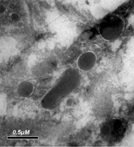 תמונת מיקרוסקופ אלקטרונים זו חושפת את החיידקים החיים בתוך תא של גידול סרטני. ד"ר רביד שטראוסמן, מכון ויצמן
