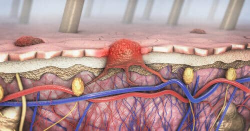 A cross-section of a skin cancer tumor (melanoma) that metastasizes into the bloodstream. Image: from shutterstock