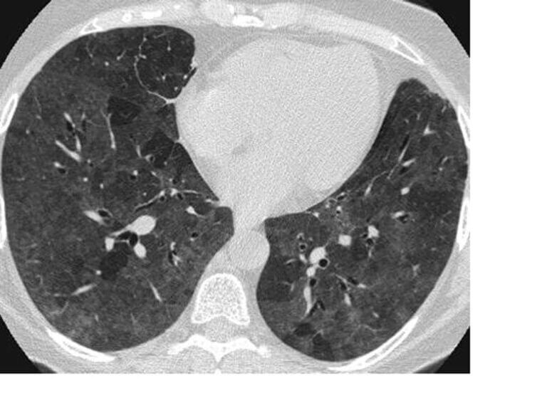 A CT scan showing the inflammatory lesions in the lungs. Mluisamtz11/Wikimedia Commons, CC BY-SA