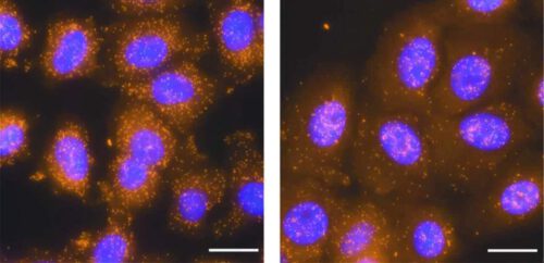 When the NXF1 protein is in the cells properly (left), the RNA molecules (orange dots) of a particular single-exon gene are exported from the nucleus (marked in purple) into the cell fluid. When NXF1 is silenced (right), RNA molecules are mostly stuck in the nucleus