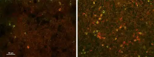 כאשר המדענים עיכבו את הייצור של חומצת הגרעין פורין ברקמה הסרטנית (מימין) יותר תאי T של המערכת החיסונית חדרו אליה בשלב האימונותרפיה, בהשוואה לרקמה שלא עברה טיפול מקדים במעכבים לפורין (משמאל). הפקת התמונות: ד"ר רעיה עילם