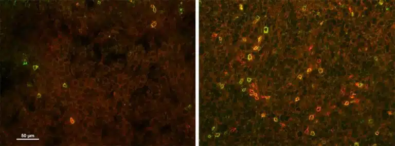 כאשר המדענים עיכבו את הייצור של חומצת הגרעין פורין ברקמה הסרטנית (מימין) יותר תאי T של המערכת החיסונית חדרו אליה בשלב האימונותרפיה, בהשוואה לרקמה שלא עברה טיפול מקדים במעכבים לפורין (משמאל). הפקת התמונות: ד"ר רעיה עילם