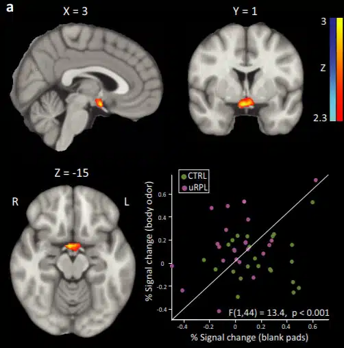 Brain activity in the hypothalamus in response to body odors. The level of activity in women who had repeated miscarriages (pink dots) was higher than in women in the control group (green dots). The laboratory of Prof. Noam Sobel, Weizmann Institute