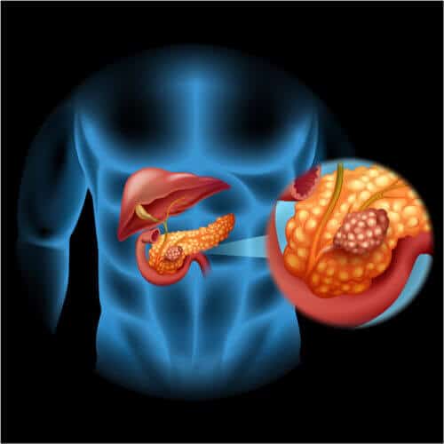 Pancreatic cancer. Illustration: Illustration: depositphotos.com