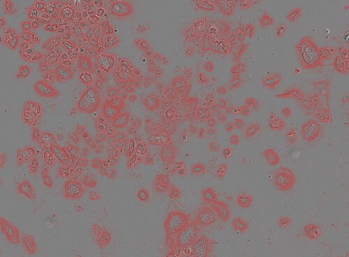 The consequences of damage to the control mechanism for the separation of chromosomes (SAC) and the KIF18A enzyme in normal cells compared to aneuploid cells