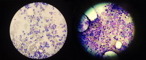 الخلايا المقاومة للأدوية في المايلوما المتعددة (اللون الأرجواني الأزرق) تحت المجهر. مختبر البروفيسور عيدو عميت، معهد وايزمان