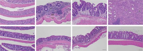 The lining of the large intestine of a mouse under a microscope. The mucosa of normal mice (top, left) malfunctions as inflammation progresses (top, middle) and promotes the development of cancer (top, right). In contrast, in mice without HSF1 (bottom, left), inflammation does not develop (bottom, middle and right)