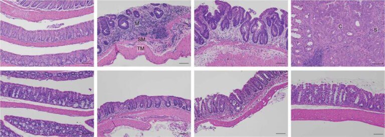 بطانة الأمعاء الغليظة لفأر تحت المجهر. يتعطل الغشاء المخاطي للفئران الطبيعية (أعلى، يسار) مع تقدم الالتهاب (أعلى، وسط) ويعزز تطور السرطان (أعلى، يمين). في المقابل، في الفئران التي لا تحتوي على HSF1 (الأسفل، اليسار)، لا يتطور الالتهاب (الأسفل، الأوسط، واليمين).