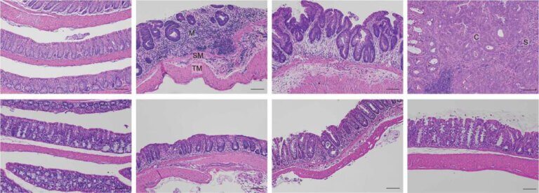 The lining of the large intestine of a mouse under a microscope. The mucosa of normal mice (top, left) malfunctions as inflammation progresses (top, middle) and promotes the development of cancer (top, right). In contrast, in mice without HSF1 (bottom, left), inflammation does not develop (bottom, middle and right)