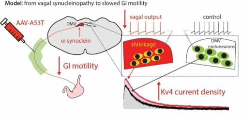 A model for the slowing down of the digestive system following the expression of alpha-synuclein protein in the brainstem. Credit - courtesy of the researchers