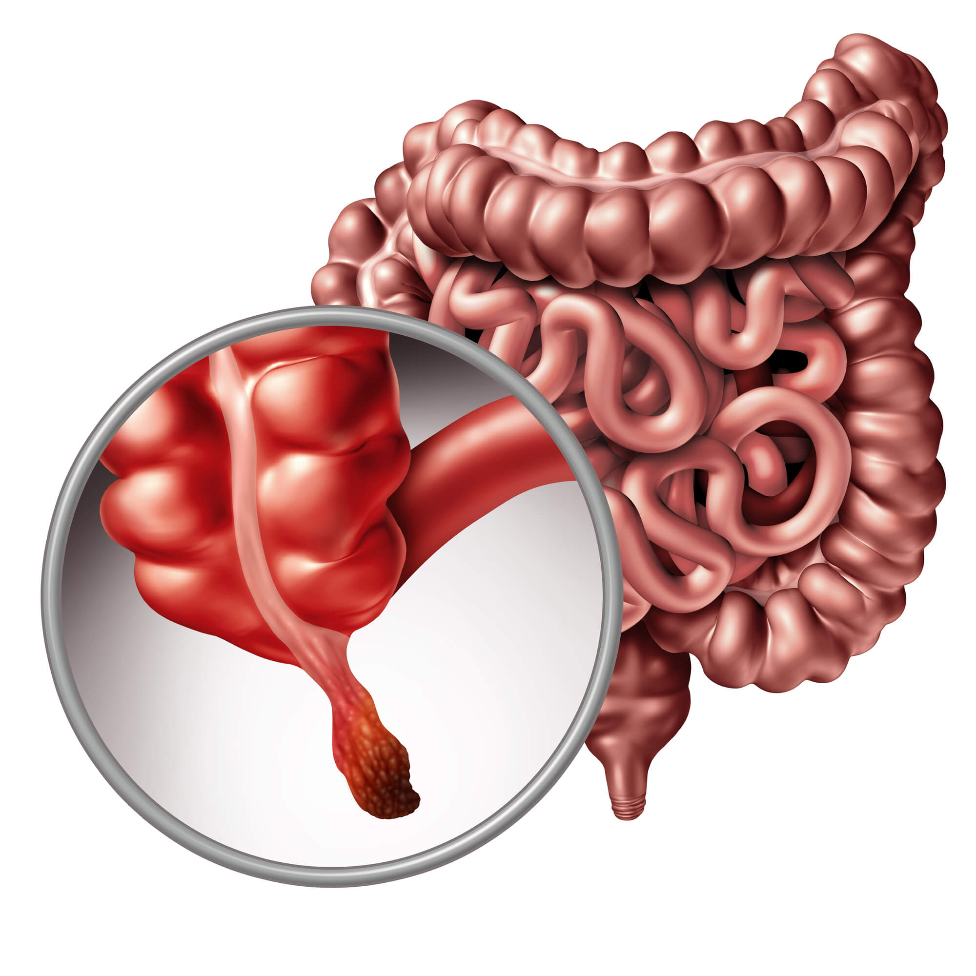 The location of the appendix in the digestive system. Image: depositphotos.com
