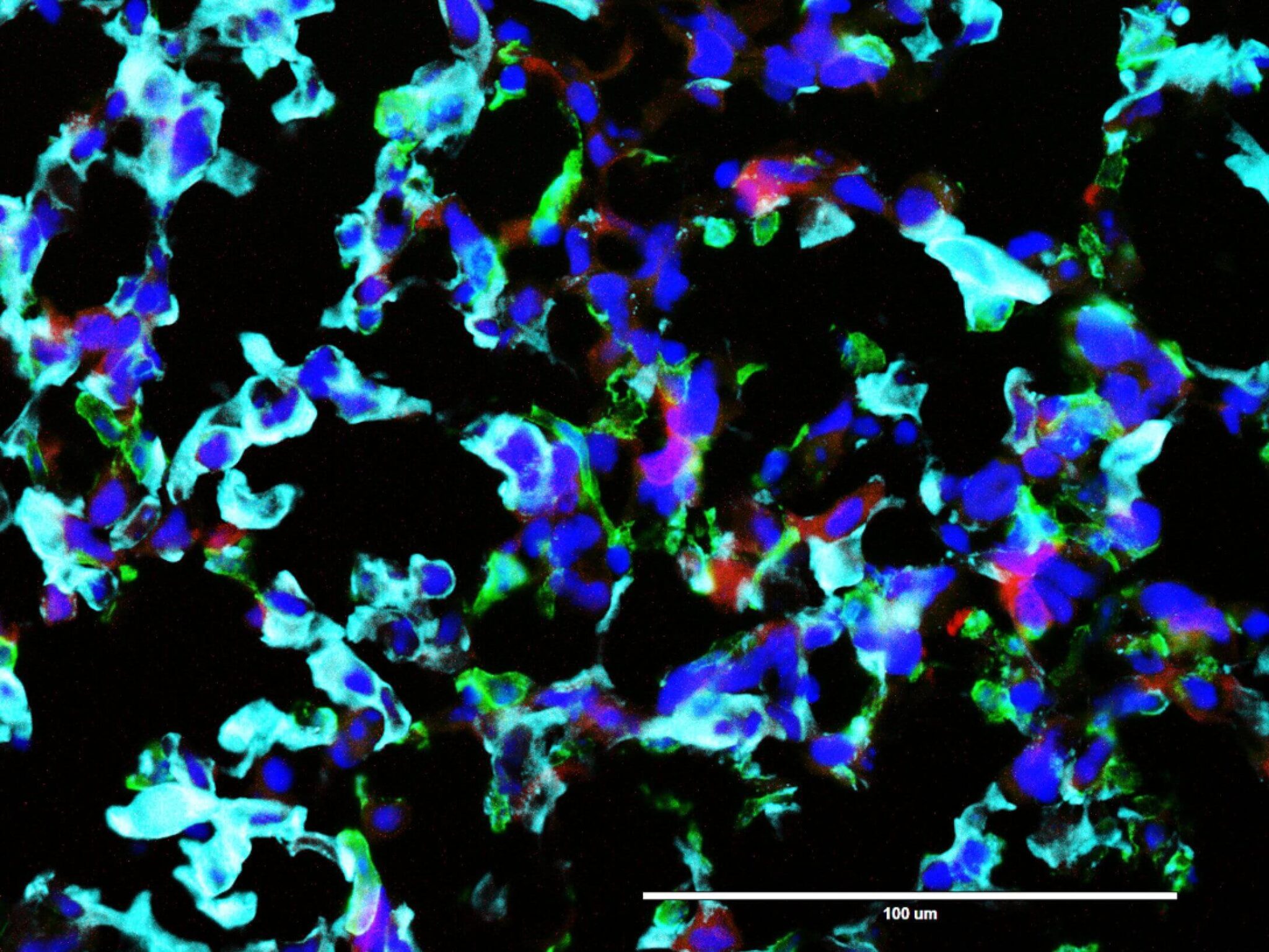 glioblastoma cancer cells. Photo courtesy of Tel Aviv University