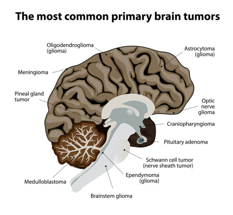 The most common types of brain cancer. Illustration: depositphotos.com