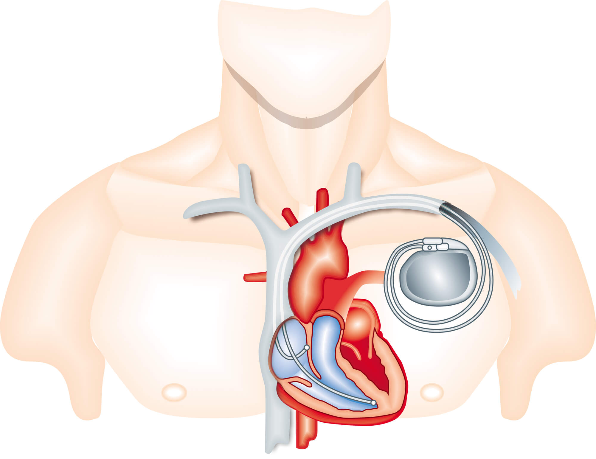 При наличии кардиостимулятора можно. Кардиостимулятор Pacemaker. Операция кардиостимулятор сердца. Имплантация сердца кардиостимулятор. Электрокардиостимулятор имплантируемый однокамерный.