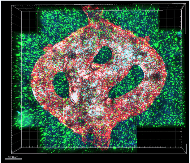 صورة مجهرية لنموذج الورم الأرومي الدبقي المطبوع ثلاثي الأبعاد. تصطف الأوعية الدموية المطبوعة بالخلايا البطانية (الحمراء) والبيريسيتات (الأزرق الفاتح). الأوعية الدموية محاطة بالخلايا السرطانية (الزرقاء) والخلايا المحيطة بالدماغ (الأخضر) ومن خلال هذه الأوعية الدموية يمكن تدفق أدوية أو خلايا مختلفة لاختبار تأثيرها على الأنسجة السرطانية.