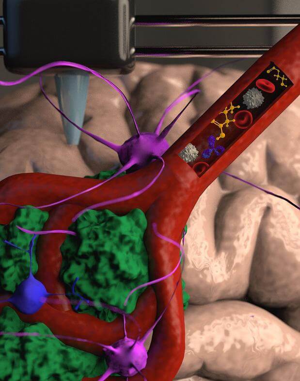 Illustration: A blood vessel printed with a XNUMXD printer inside a bioreactor containing tissue simulating the human brain along with cancer cells from a patient. Various drugs, cells and immunotherapy treatments can be injected into the blood vessels. Credit: Victoria Hughes