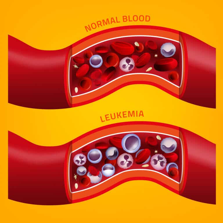 Blood cancer cells compared to normal blood cells. Illustration: depositphotos.com