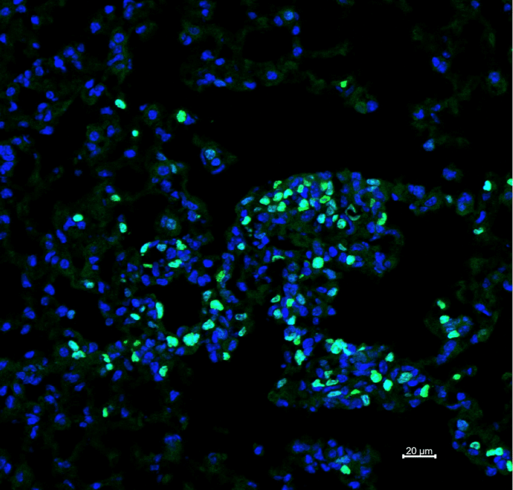 Proliferation of cancer cells in mice without eosinophils Credit: Tel Aviv University