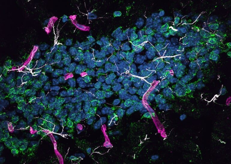 Protein from the liver can cause Alzheimer's disease in the brain thumbnail