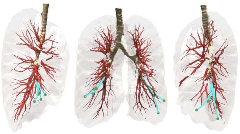 באיור: שלושה מבטים על ביופסיה של הריאה בטכנולוגיה החדשה. המחטים (בירוק) נעות אל המטרה תוך עקיפה של מכשולים אנטומיים ובהם כלי דם גדולים (באדום), רקמת הריאה (באפור) והסמפונות (בחום) – הצינורות המחברים את קנה הנשימה לריאות. פרופ' אורן זלצמן, הטכניון