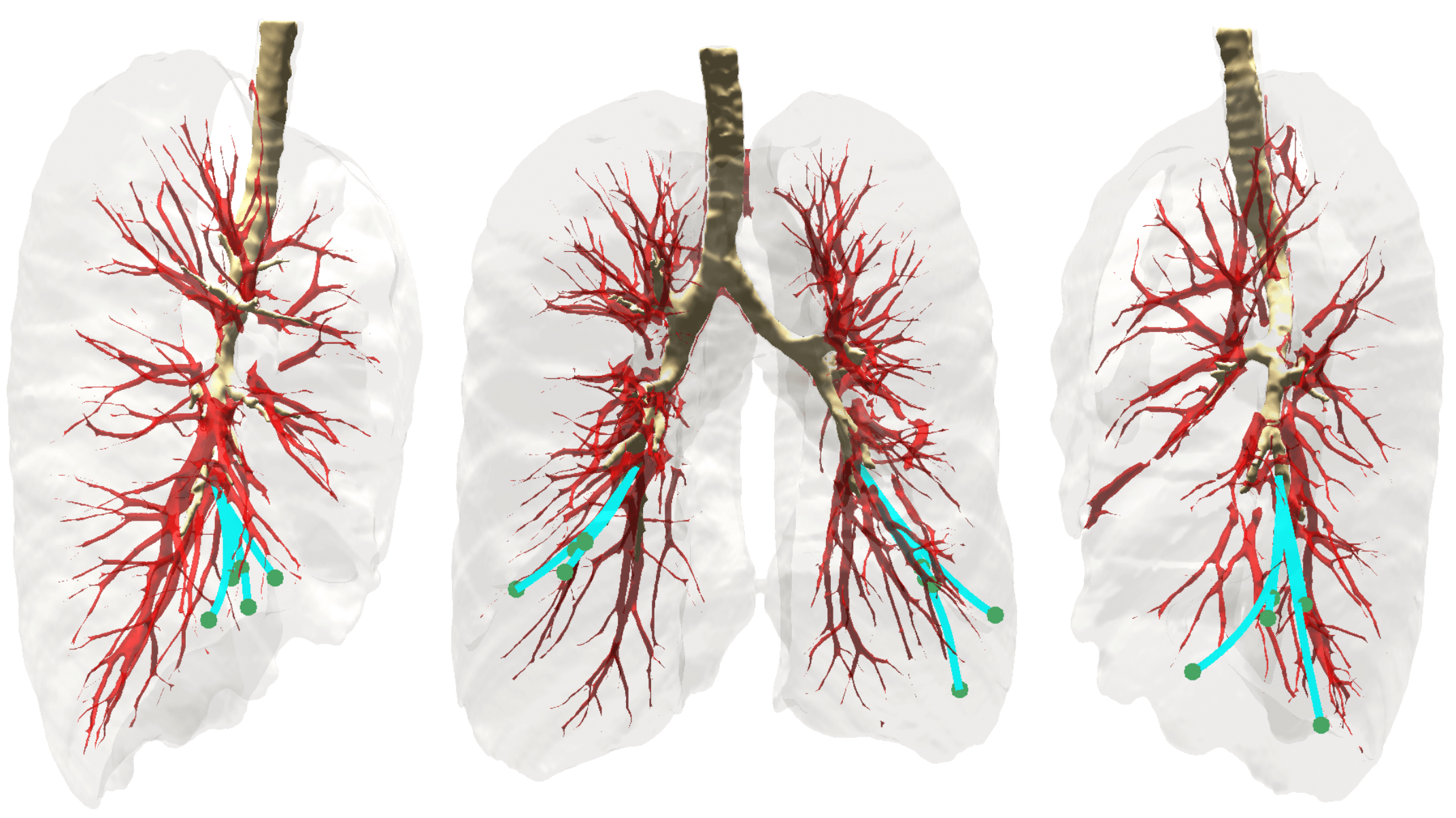 באיור: שלושה מבטים על ביופסיה של הריאה בטכנולוגיה החדשה. המחטים (בירוק) נעות אל המטרה תוך עקיפה של מכשולים אנטומיים ובהם כלי דם גדולים (באדום), רקמת הריאה (באפור) והסמפונות (בחום) – הצינורות המחברים את קנה הנשימה לריאות. פרופ' אורן זלצמן, הטכניון