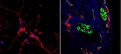 בתמונה מימין: חתך היסטולוגי של רקמת סרטן השד (גרעיני התאים צבועים בכחול). אפשר לראות את זרימת הננו-חלקיקים (באדום) דרך כלי הדם (בצהוב) ואת הצטברותם סביב סיבי העצב (בירוק). בתמונה משמאל: הצטברותם של הננו-חלקיקים בתרבית תאים של נוירונים (באדום - הננו-חלקיקים, בכחול - גרעיני התאים).