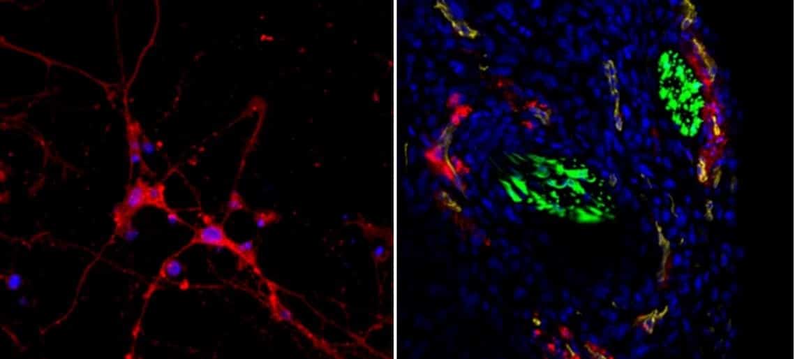 In the picture on the right: a histological section of breast cancer tissue (cell nuclei are colored blue). You can see the flow of the nanoparticles (in red) through the blood vessels (in yellow) and their accumulation around the nerve fibers (in green). In the picture on the left: the accumulation of the nanoparticles in cell culture of neurons (in red - the nanoparticles, in blue - the cell nuclei).