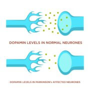 תאי עצב של אדם בריא (למעלה) בהשוואה לתא דומה של חולה פרקינסון. המחסור בדופאמין גורם להפרעות נוירולוגיות. המחשה: depositphotos.com