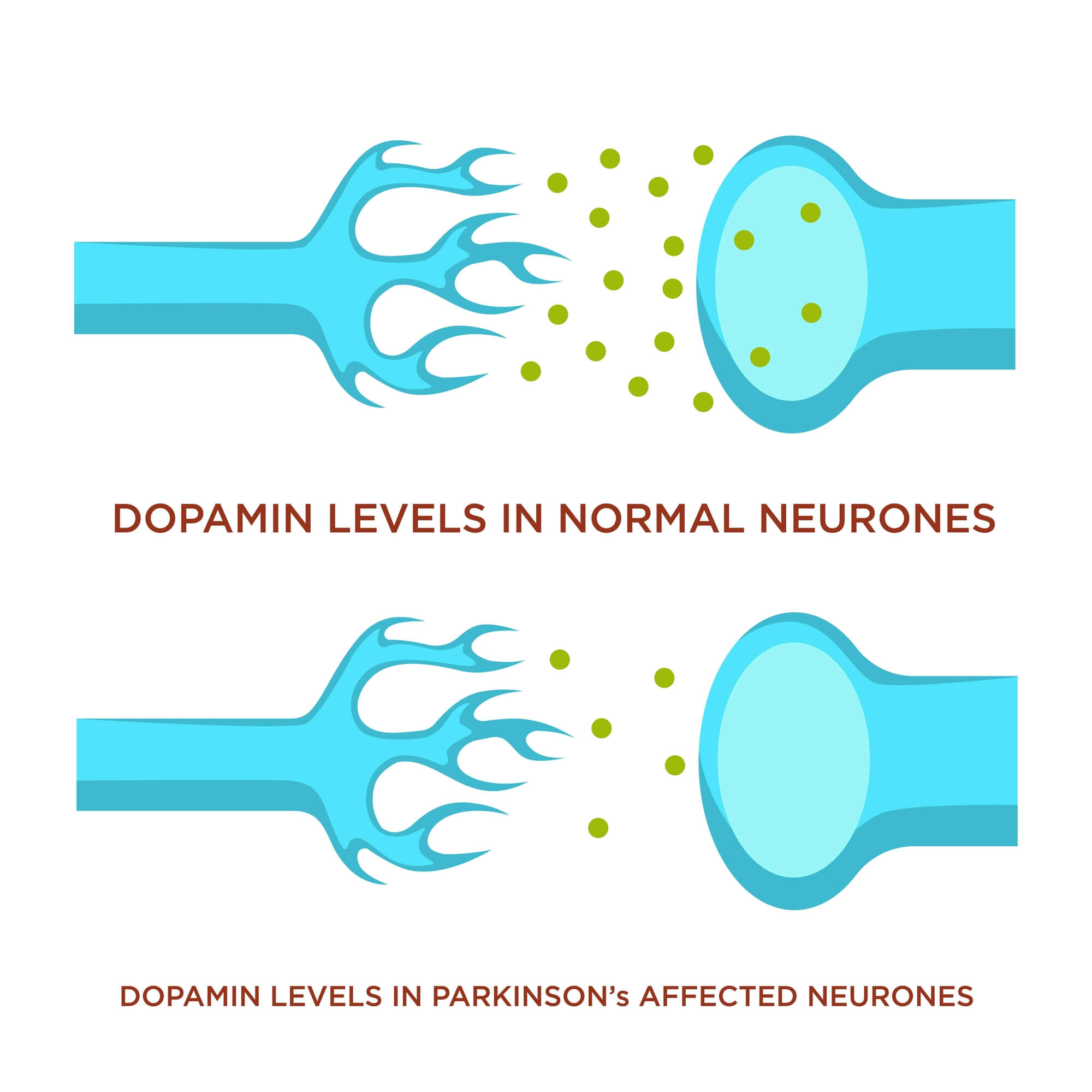 תאי עצב של אדם בריא (למעלה) בהשוואה לתא דומה של חולה פרקינסון. המחסור בדופאמין גורם להפרעות נוירולוגיות.  <a href="https://depositphotos.com. ">המחשה: depositphotos.com</a>
