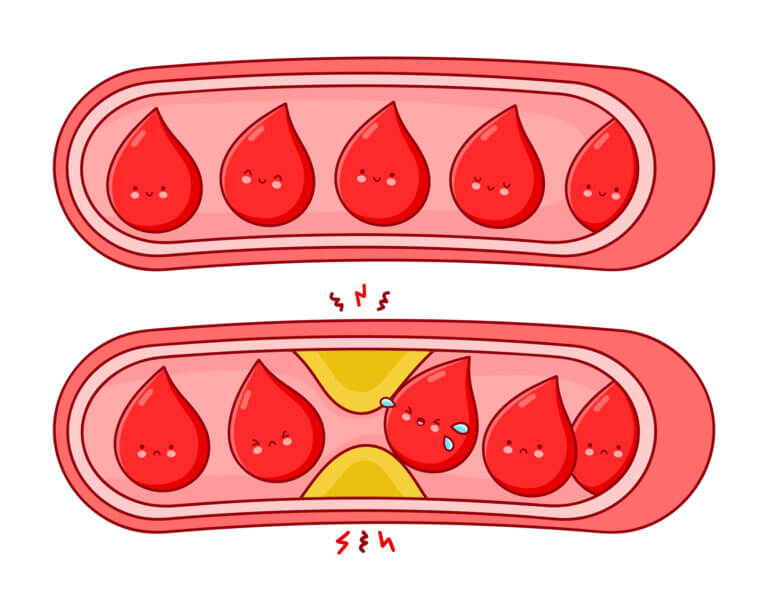 כלי דם בריאים לעומת כלי דם סתומים. המחשה: depositphotos.com